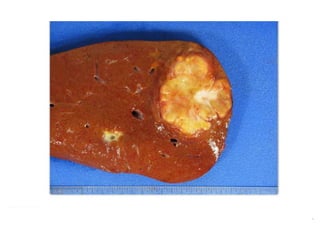 Liver specimen: Hepatocellular carcinoma, liver abscess | PPTX