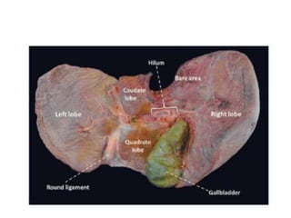 Liver specimen: Hepatocellular carcinoma, liver abscess | PPTX