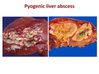 Liver specimen: Hepatocellular carcinoma, liver abscess | PPTX
