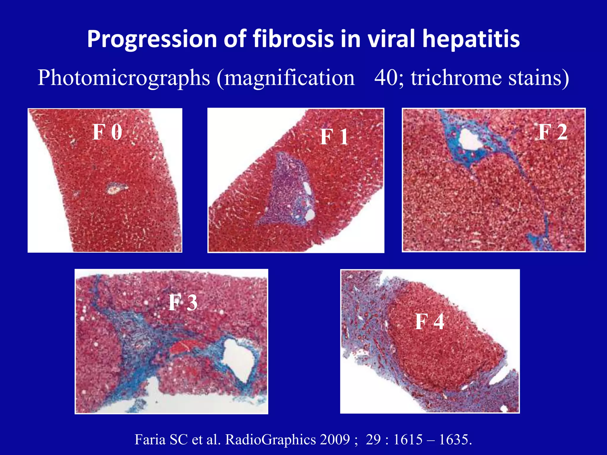 Progression of fibrosis in viral hepatitis
Photomicrographs (magnification 40; trichrome stains)
Faria SC et al. RadioGraphics 2009 ; 29 : 1615 – 1635.
F 0 F 1 F 2
F 3
F 4
 