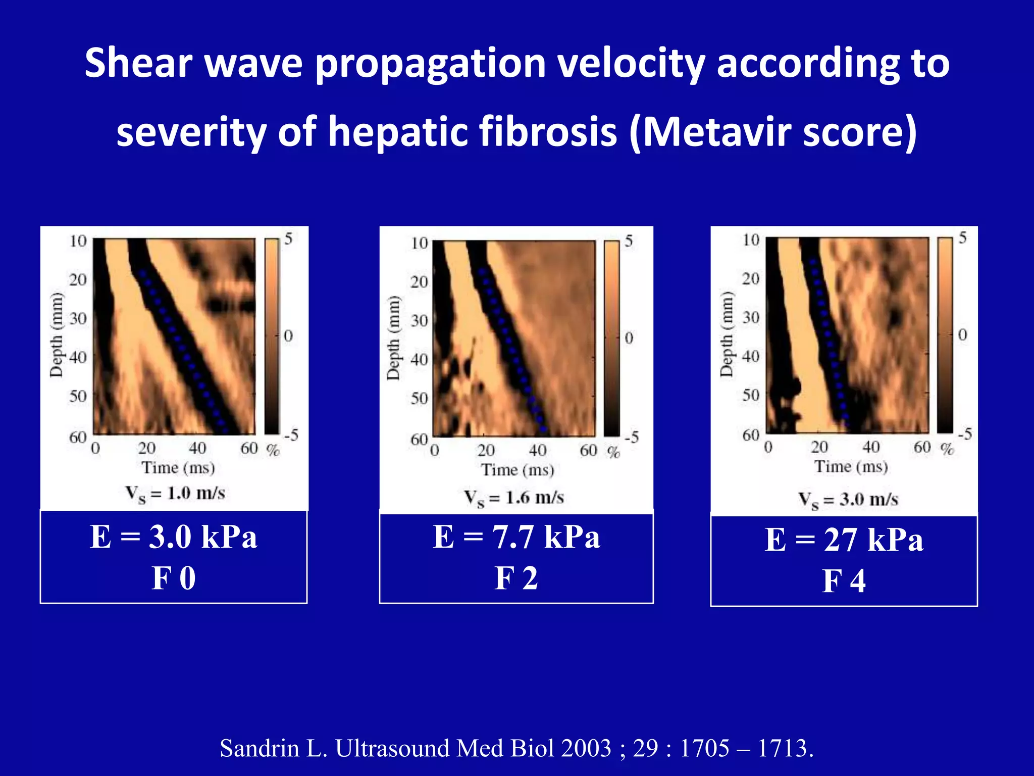 Shear wave propagation velocity according to
severity of hepatic fibrosis (Metavir score)
Sandrin L. Ultrasound Med Biol 2003 ; 29 : 1705 – 1713.
E = 3.0 kPa
F 0
E = 7.7 kPa
F 2
E = 27 kPa
F 4
 