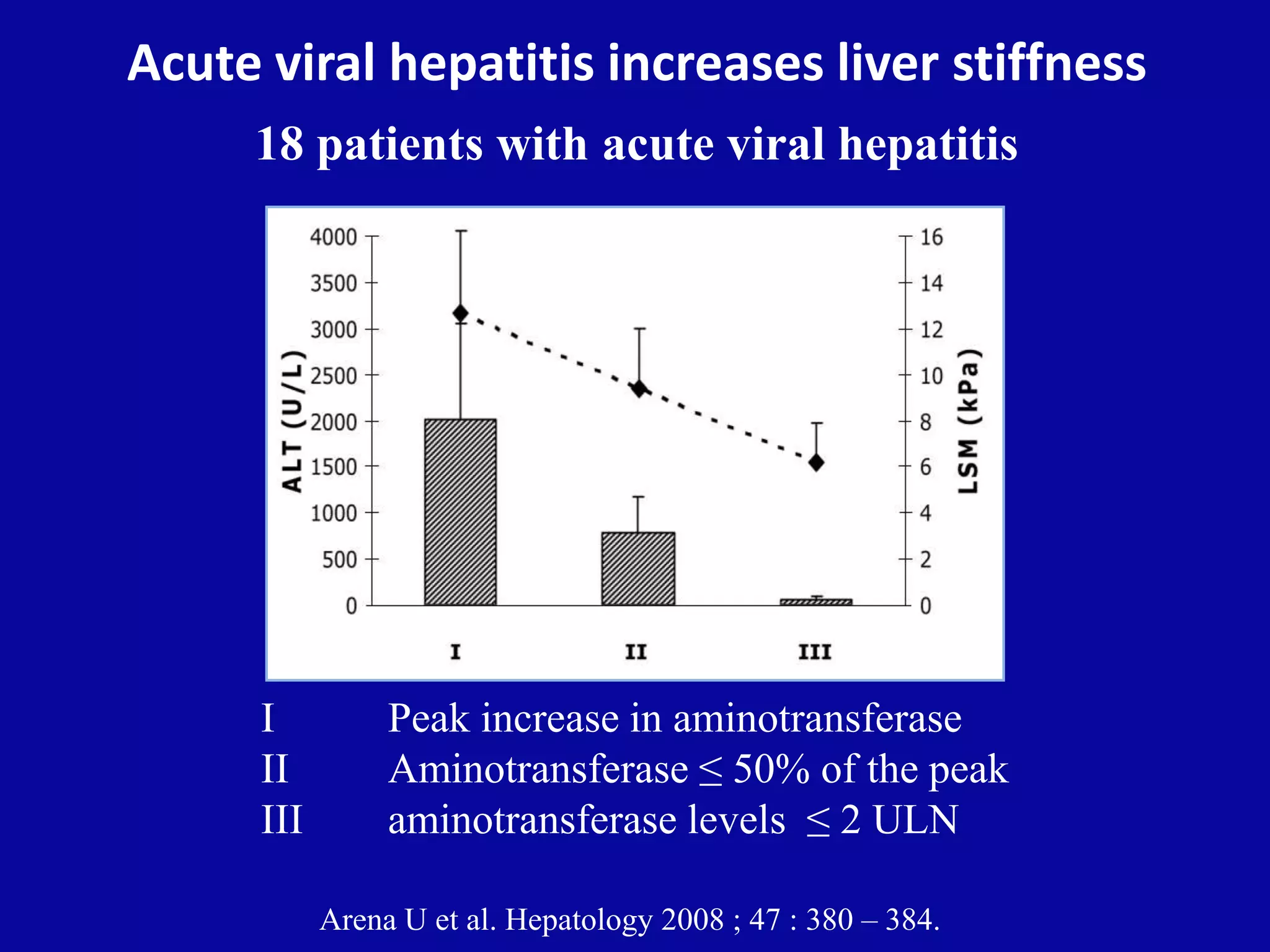 Acute viral hepatitis increases liver stiffness
18 patients with acute viral hepatitis
I Peak increase in aminotransferase
II Aminotransferase ≤ 50% of the peak
III aminotransferase levels ≤ 2 ULN
Arena U et al. Hepatology 2008 ; 47 : 380 – 384.
 