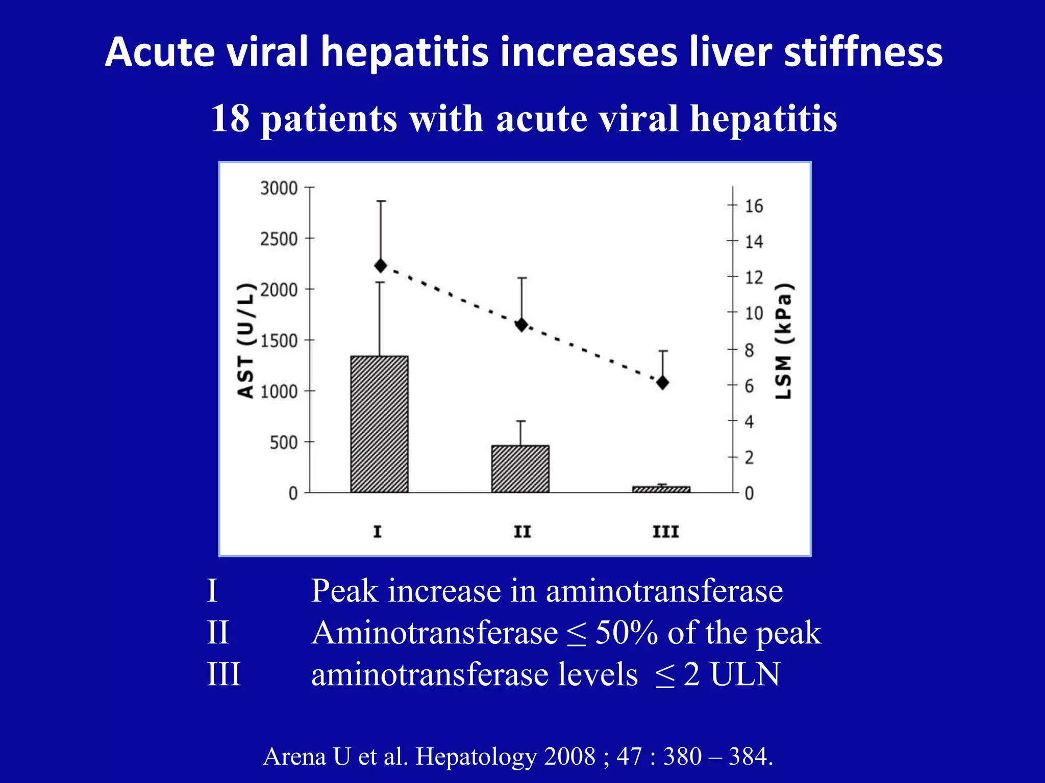 Acute viral hepatitis increases liver stiffness
18 patients with acute viral hepatitis
I Peak increase in aminotransferase
II Aminotransferase ≤ 50% of the peak
III aminotransferase levels ≤ 2 ULN
Arena U et al. Hepatology 2008 ; 47 : 380 – 384.
 