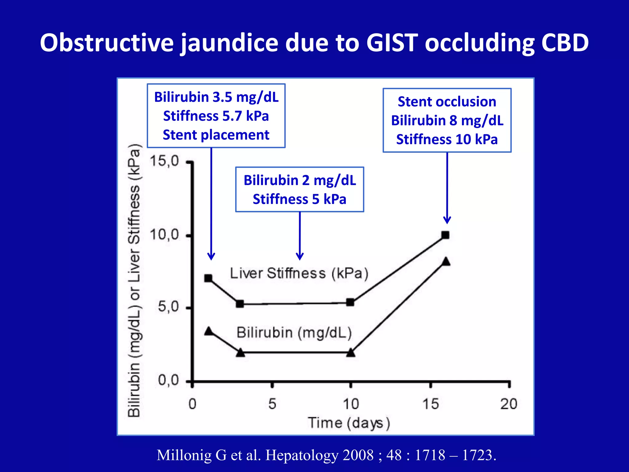 Obstructive jaundice due to GIST occluding CBD
Millonig G et al. Hepatology 2008 ; 48 : 1718 – 1723.
Stent occlusion
Bilirubin 8 mg/dL
Stiffness 10 kPa
Bilirubin 3.5 mg/dL
Stiffness 5.7 kPa
Stent placement
Bilirubin 2 mg/dL
Stiffness 5 kPa
 