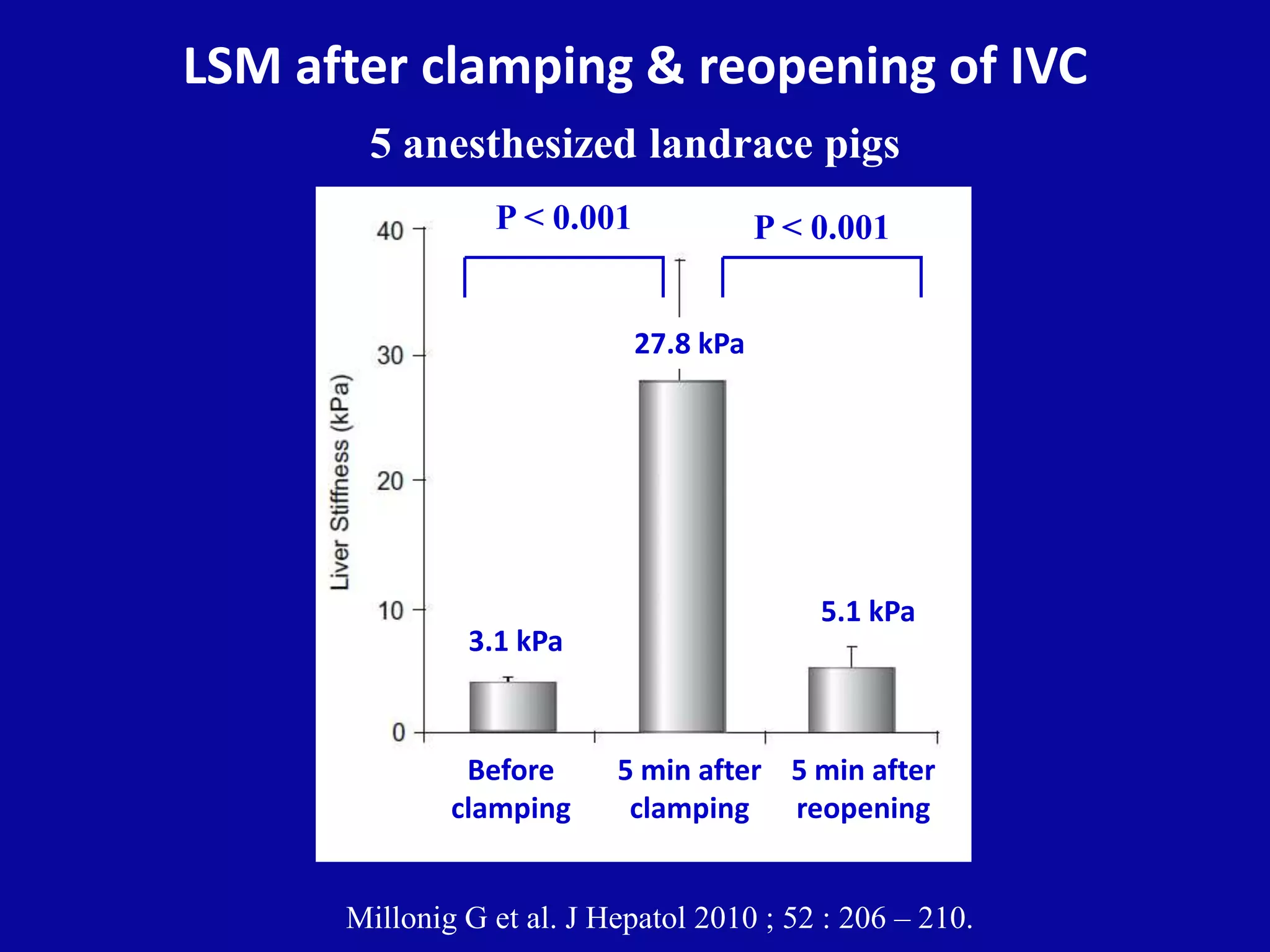 LSM after clamping & reopening of IVC
5 anesthesized landrace pigs
Millonig G et al. J Hepatol 2010 ; 52 : 206 – 210.
P < 0.001 P < 0.001
Before
clamping
3.1 kPa
5 min after
reopening
5.1 kPa
27.8 kPa
5 min after
clamping
 
