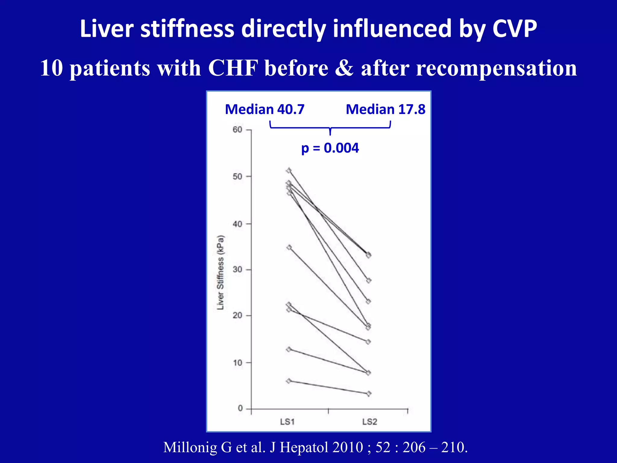 Liver stiffness directly influenced by CVP
10 patients with CHF before & after recompensation
Millonig G et al. J Hepatol 2010 ; 52 : 206 – 210.
Median 40.7 Median 17.8
p = 0.004
 