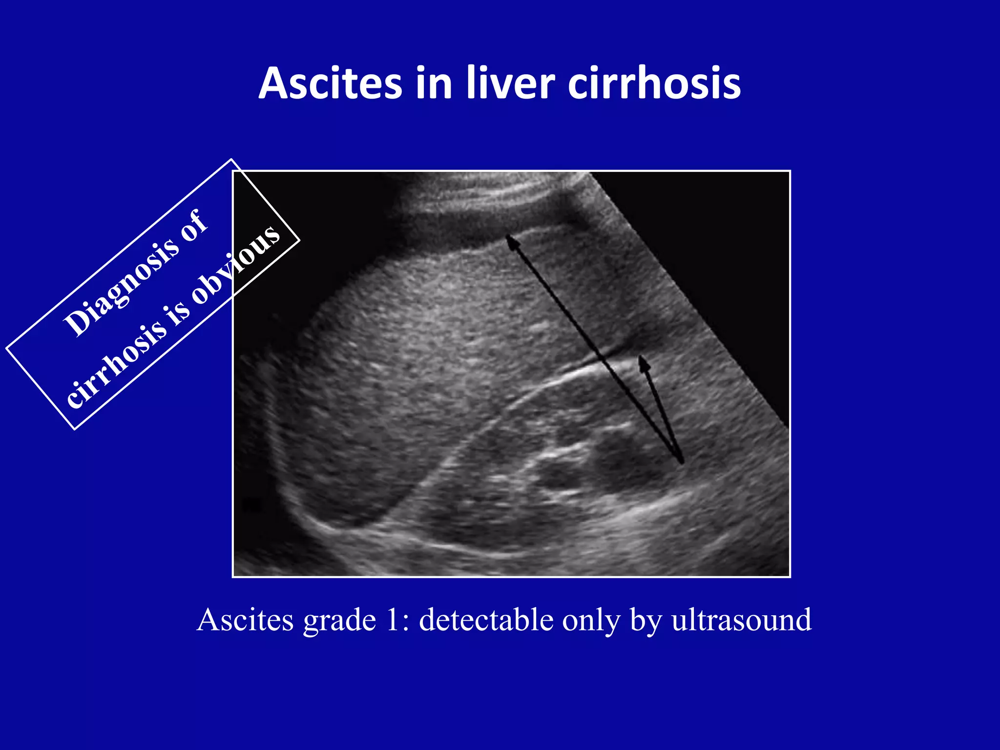 Ascites in liver cirrhosis
Ascites grade 1: detectable only by ultrasound
 