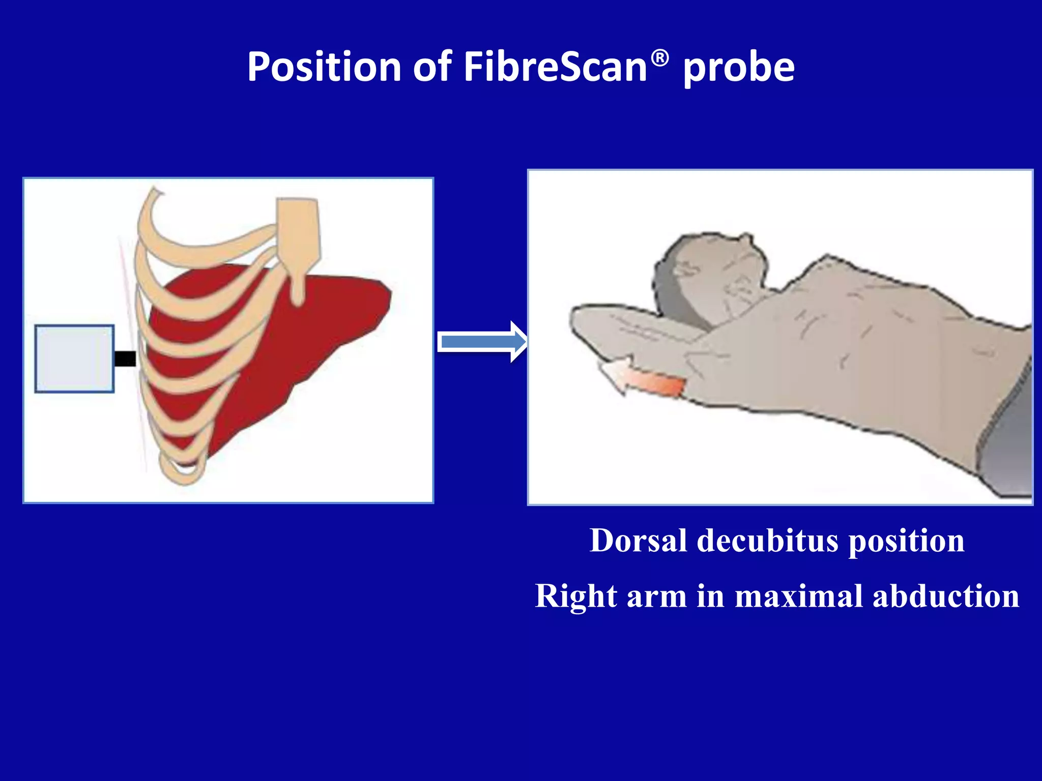 Position of FibreScan® probe
Dorsal decubitus position
Right arm in maximal abduction
 