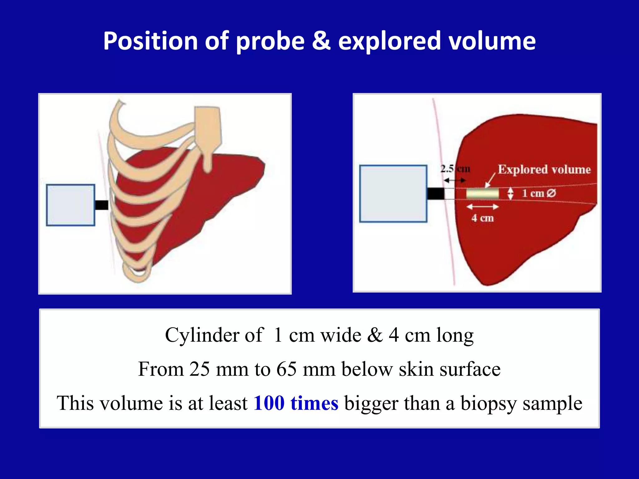 Position of probe & explored volume
Cylinder of 1 cm wide & 4 cm long
From 25 mm to 65 mm below skin surface
This volume is at least 100 times bigger than a biopsy sample
 