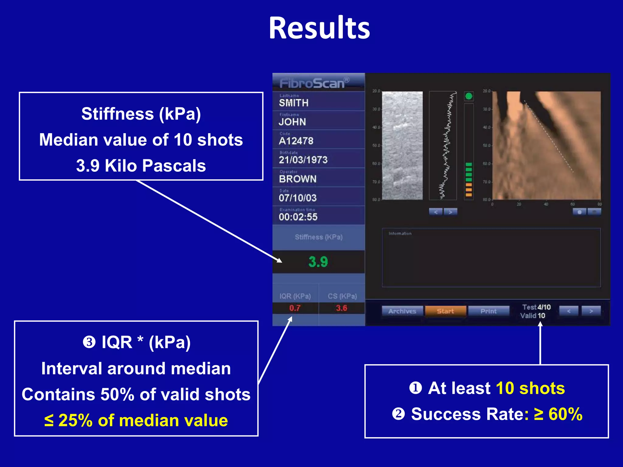 Results
Stiffness (kPa)
Median value of 10 shots
3.9 Kilo Pascals
 At least 10 shots
 Success Rate: ≥ 60%
 IQR * (kPa)
Interval around median
Contains 50% of valid shots
≤ 25% of median value
 