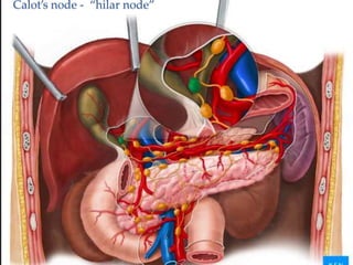 Calot’s node - “hilar node”
 