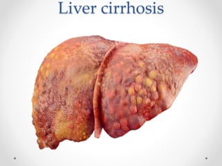Liver cirrhosis
 