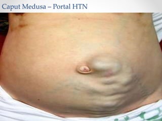 Caput Medusa – Portal HTN
 