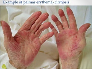 Example of palmar erythema- cirrhosis
 