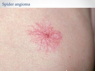 Spider angioma
 