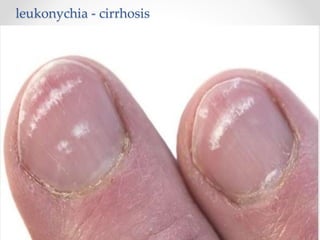leukonychia - cirrhosis
 