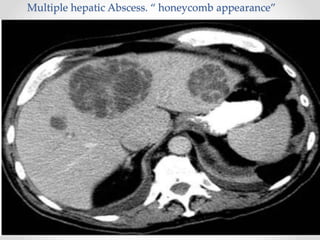 Multiple hepatic Abscess. “ honeycomb appearance”
 
