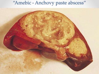“Amebic - Anchovy paste abscess”
 