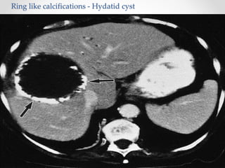 Ring like calcifications - Hydatid cyst
 