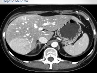 Hepatic adenoma
 
