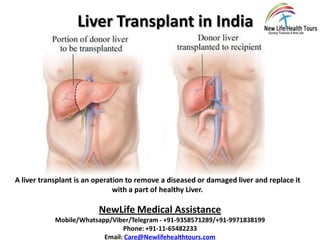 Liver Transplant in India
A liver transplant is an operation to remove a diseased or damaged liver and replace it
with a part of healthy Liver.
NewLife Medical Assistance
Mobile/Whatsapp/Viber/Telegram - +91-9358571289/+91-9971838199
Phone: +91-11-65482233
Email: Care@Newlifehealthtours.com
 
