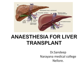 ANAESTHESIA FOR LIVER
TRANSPLANT
Dr.Sandeep
Narayana medical college
Nellore.
 