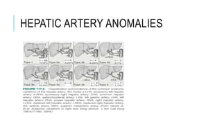 HEPATIC ARTERY ANOMALIES
 