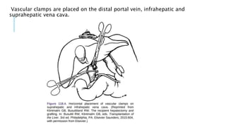Vascular clamps are placed on the distal portal vein, infrahepatic and
suprahepatic vena cava.
 
