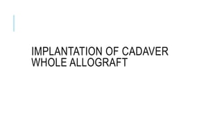 IMPLANTATION OF CADAVER
WHOLE ALLOGRAFT
 