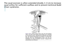 The caval excision is often extended distally 3-4 cm to increase
caval orifice for sufficient outflow and to prevent technical Budd
Chiari syndrome.
 