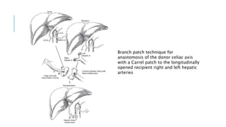 Branch patch technique for
anastomosis of the donor celiac axis
with a Carrel patch to the longitudinally
opened recipient right and left hepatic
arteries
 