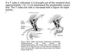 If a T-tube is indicated, it is brought out of the recipient duct
approximately 1 to 1.5 cm downward the anastomotic suture
line. The T-tube exit side is narrowed with a figure-of-eight
suture .
 