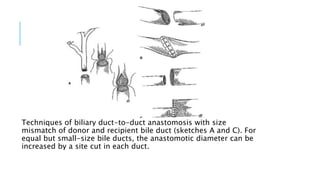 Techniques of biliary duct-to-duct anastomosis with size
mismatch of donor and recipient bile duct (sketches A and C). For
equal but small-size bile ducts, the anastomotic diameter can be
increased by a site cut in each duct.
 