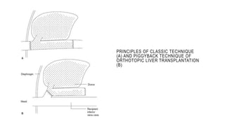 PRINCIPLES OF CLASSIC TECHNIQUE
(A) AND PIGGYBACK TECHNIQUE OF
ORTHOTOPIC LIVER TRANSPLANTATION
(B)
 