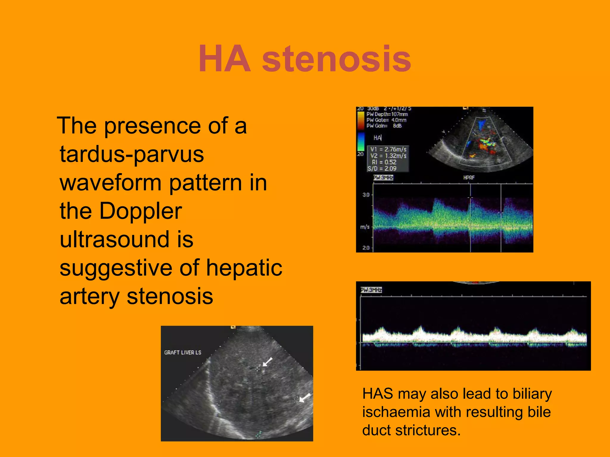 Parvus Liver transplant evaluation | PPT