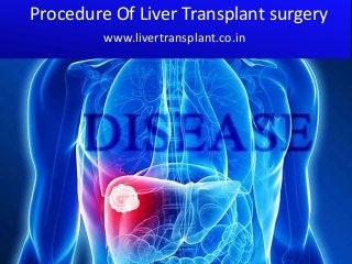 Procedure Of Liver Transplant surgery 
www.livertransplant.co.in 
 