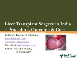 Liver Transplant Surgery in India
– Procedure, Outcome & Cost
IndiCure Treatment Solutions
www.indicure.com
www.indicure.com.ng
E-mail – info@indicure.com
Call at - +91 98184 62127,
+91 93200 36777

 