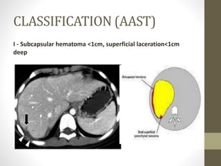 CLASSIFICATION (AAST)
I - Subcapsular hematoma <1cm, superficial laceration<1cm
deep
 