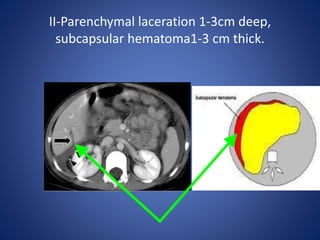 II-Parenchymal laceration 1-3cm deep,
subcapsular hematoma1-3 cm thick.
 
