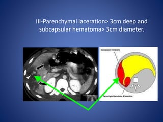 III-Parenchymal laceration> 3cm deep and
subcapsular hematoma> 3cm diameter.
 