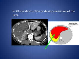 V- Global destruction or devascularization of the
liver.
 