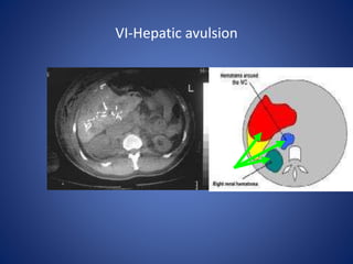 VI-Hepatic avulsion
 