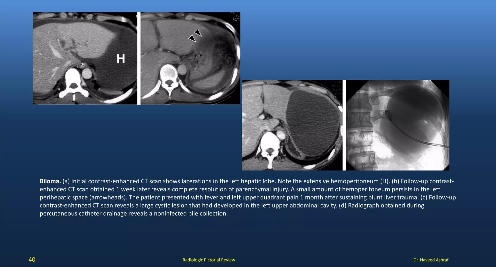 Devascularization Ct Liver trauma | PDF