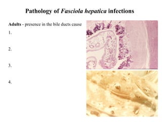 Pathology of  Fasciola hepatica  infections Adults  - presence in the bile ducts cause 1. 2. 3. 4. 