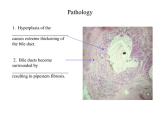 Pathology 1.  Hyperplasia of the _________________________causes extreme thickening of the bile duct.    2.  Bile ducts become surrounded by _________________________ resulting in pipestem fibrosis. 