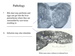 Pathology Bile duct may perforate and eggs can get into the liver parenchyma where they are surrounded by scar tissue resulting in  ________________________ 4.  Infection may also stimulate ________________________   White areas show cirrhosis in infected liver 