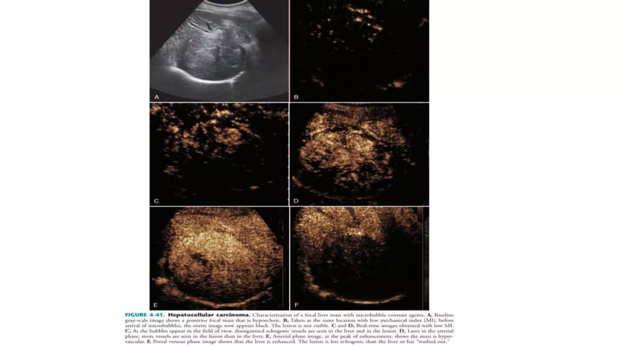 Ultrasonography of hepatic mass lesion | PPTX