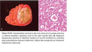 Liver tumors [Benign and Malignant]