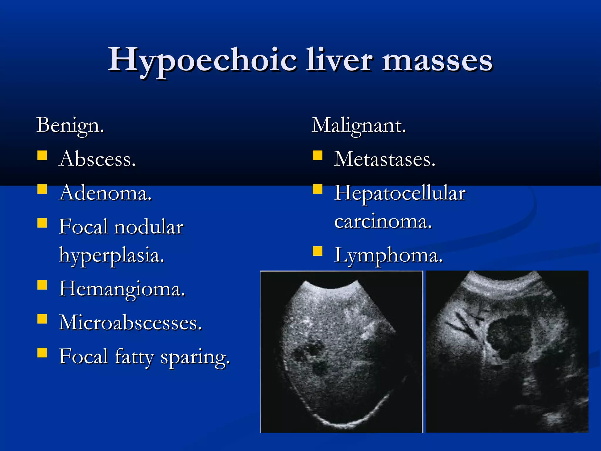 Hypoechoic liver massesHypoechoic liver masses
Benign.Benign.
 Abscess.Abscess.
 Adenoma.Adenoma.
 Focal nodularFocal nodular
hyperplasia.hyperplasia.
 Hemangioma.Hemangioma.
 Microabscesses.Microabscesses.
 Focal fatty sparing.Focal fatty sparing.
Malignant.Malignant.
 Metastases.Metastases.
 HepatocellularHepatocellular
carcinoma.carcinoma.
 Lymphoma.Lymphoma.
 