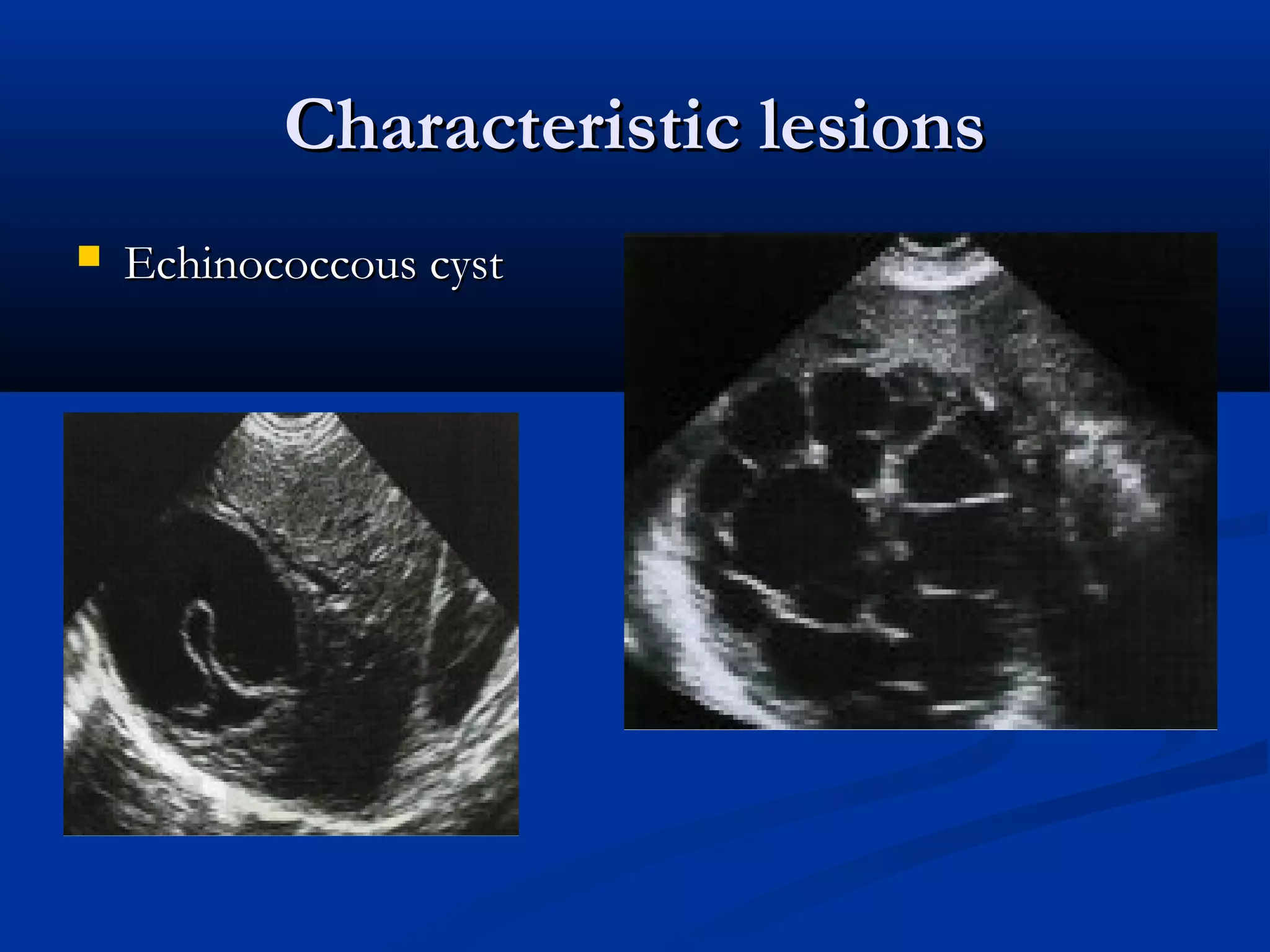 Characteristic lesionsCharacteristic lesions
 Echinococcous cystEchinococcous cyst
 